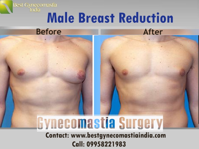 male-breast-reduction