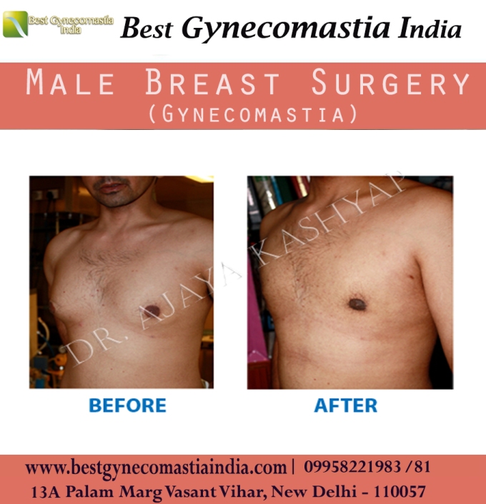 #Gynecomastia, #chest, #areola, #weight, #nipple, #AjayaKashyap, #malebreastreduction, #malechestsurgery, #surgeon, #clinic, #delhi, #southdelhi, #india