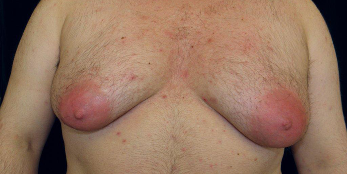 cheapest gynecomastia surgery, gynecomastia medical treatment, best liposuction surgeon in india, low cost surgery clinic, moobs surgery cost in india, cosmetic surgery consultation in south delhi, flat chest men