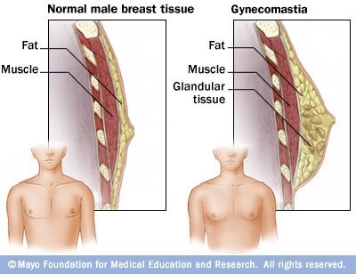 gynecomastia, male breast reduction, puffy nipple surgery, male chest reduction surgeon, gynecomastia specialist near me