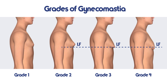 #Gynecomastia #Grade #MaleBreastReduction #Slimfit #Summer